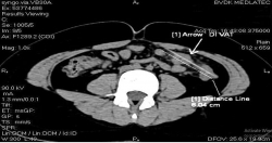 Cháu bé 10 tuổi cấp cứu bệnh viện vì nuốt phải dị vật khi... ăn ốc